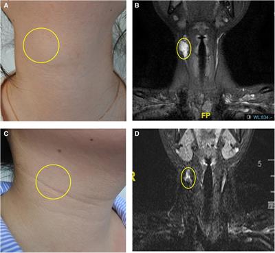 Therapeutic evaluation and analysis of complications of ethanol sclerotherapy for intramuscular vascular malformations: a single-center retrospective study